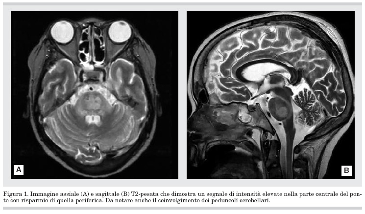 Risultato di sindrome di astinenza